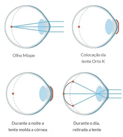 Como funcionam as lentes Orto-K