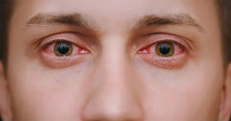 Olhos vermelhos: causas e tratamentos Olhos vermelhos: causas e tratamentos