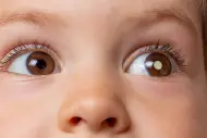 Retinoblastoma: o que é, sintomas e tratamento Retinoblastoma: o que é, sintomas e tratamento