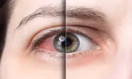 Infeções oculares causados por estreptococos Infeções oculares causados por estreptococos