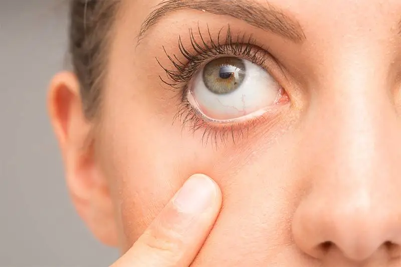 Tique no olho causas Tique no olho causas